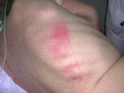 DÍA DE PREVENCIÓN DE ÚLCERAS POR PRESIÓN Y LESIONES